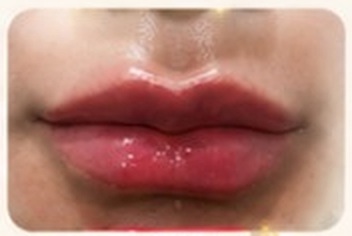 Bibir sesudah filler