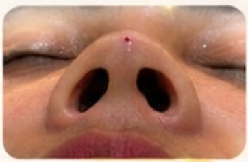 Hidung sesudah perawatan