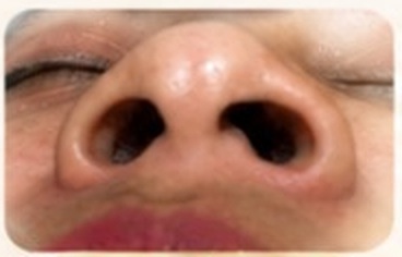 Hidung sebelum perawatan