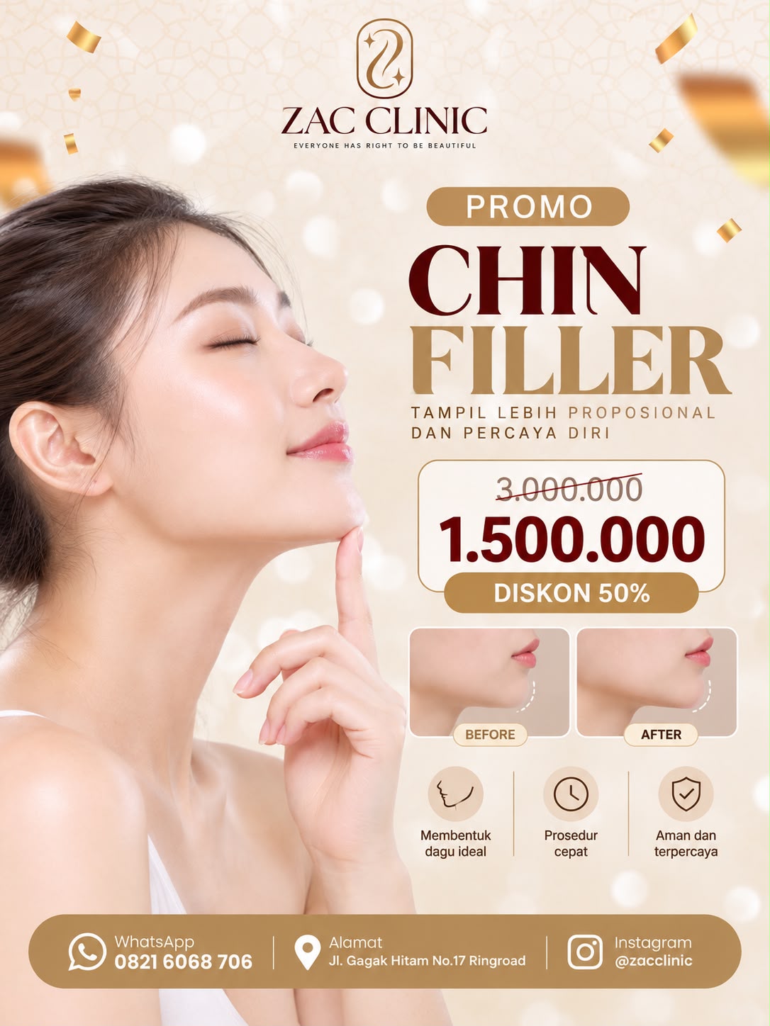 Chin Filler- V Shape