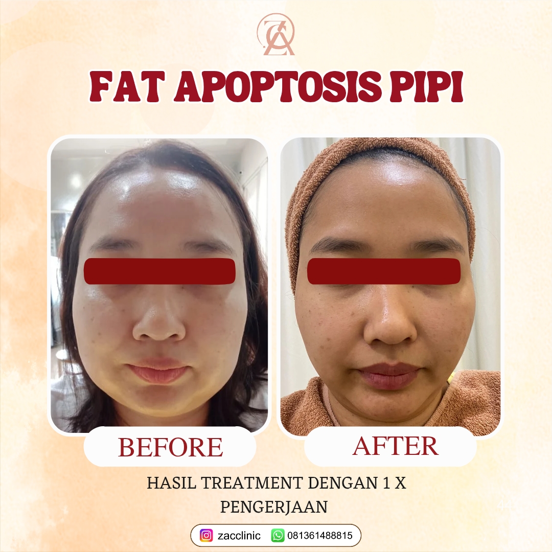 Fat Apoptosis Before&After