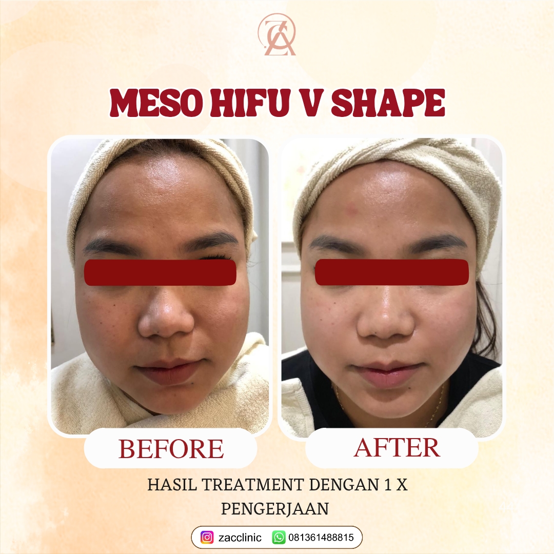 Before After Meso Hifu